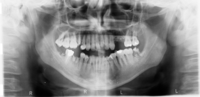 snímek zubů